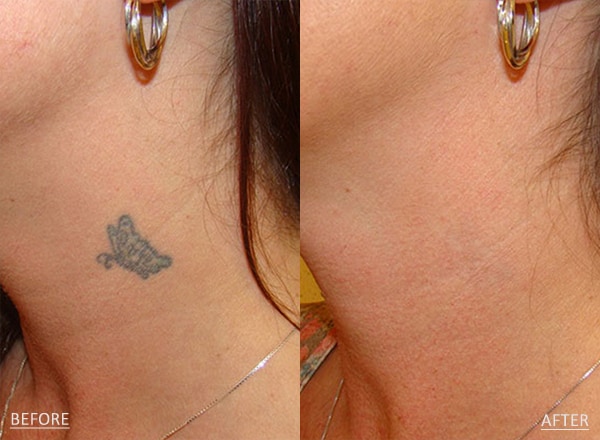 Laser Tattoo Removal  Before and After through all the stages  YouTube